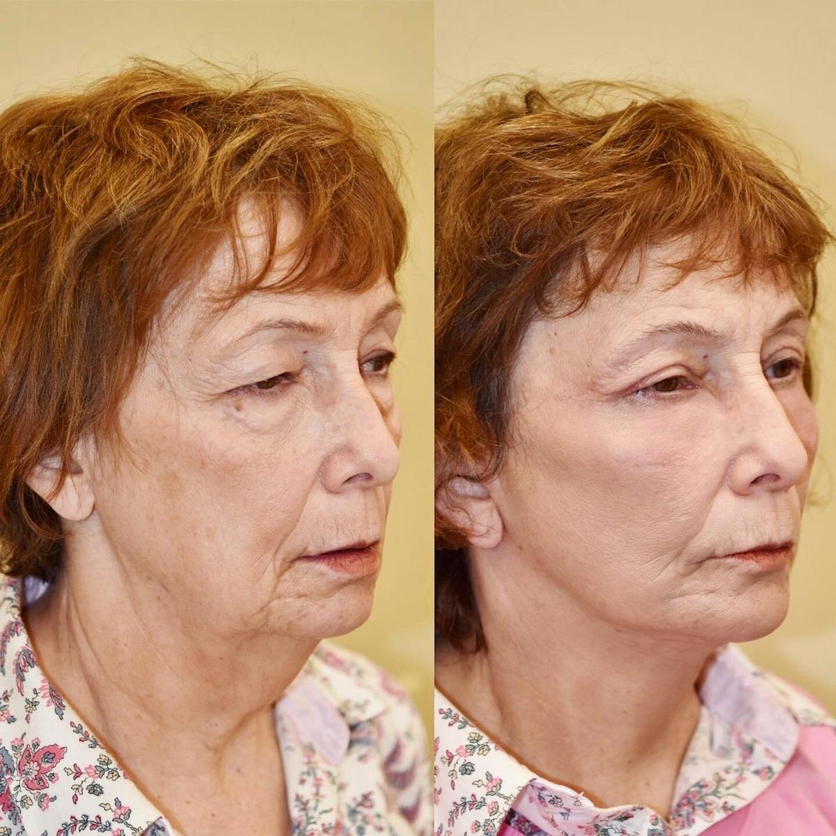 Neck Lift Before & After Gallery - Patient 614430 - Image 2