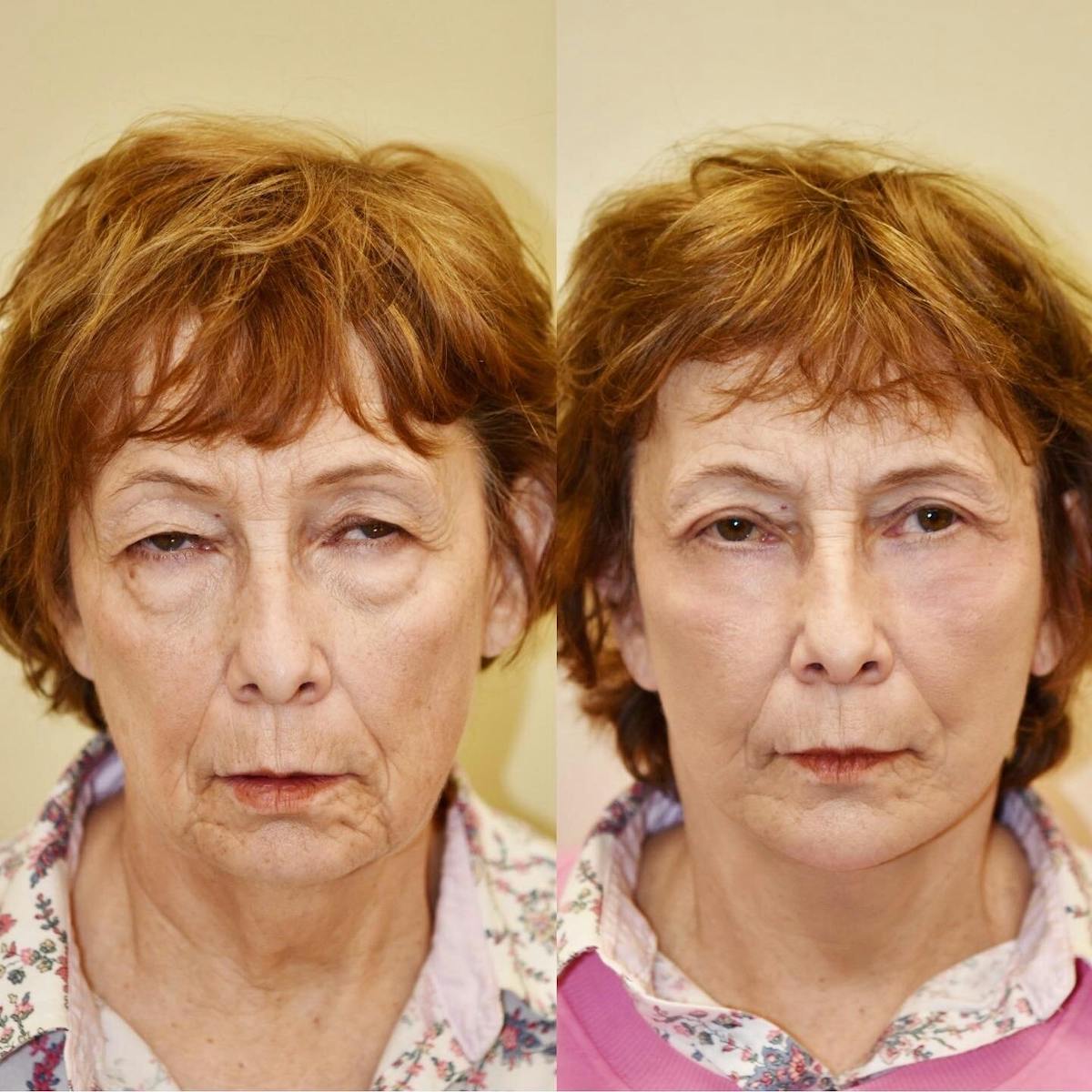 Neck Lift Before & After Gallery - Patient 614430 - Image 3