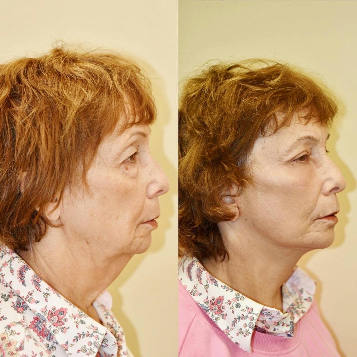Neck Lift Before & After Gallery - Patient 614430 - Image 4
