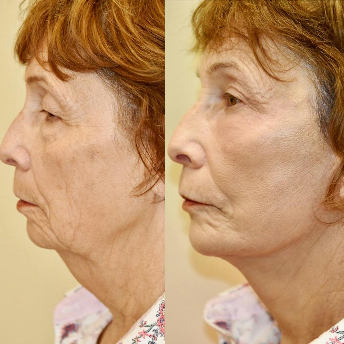 Neck Lift Before & After Gallery - Patient 614430 - Image 5