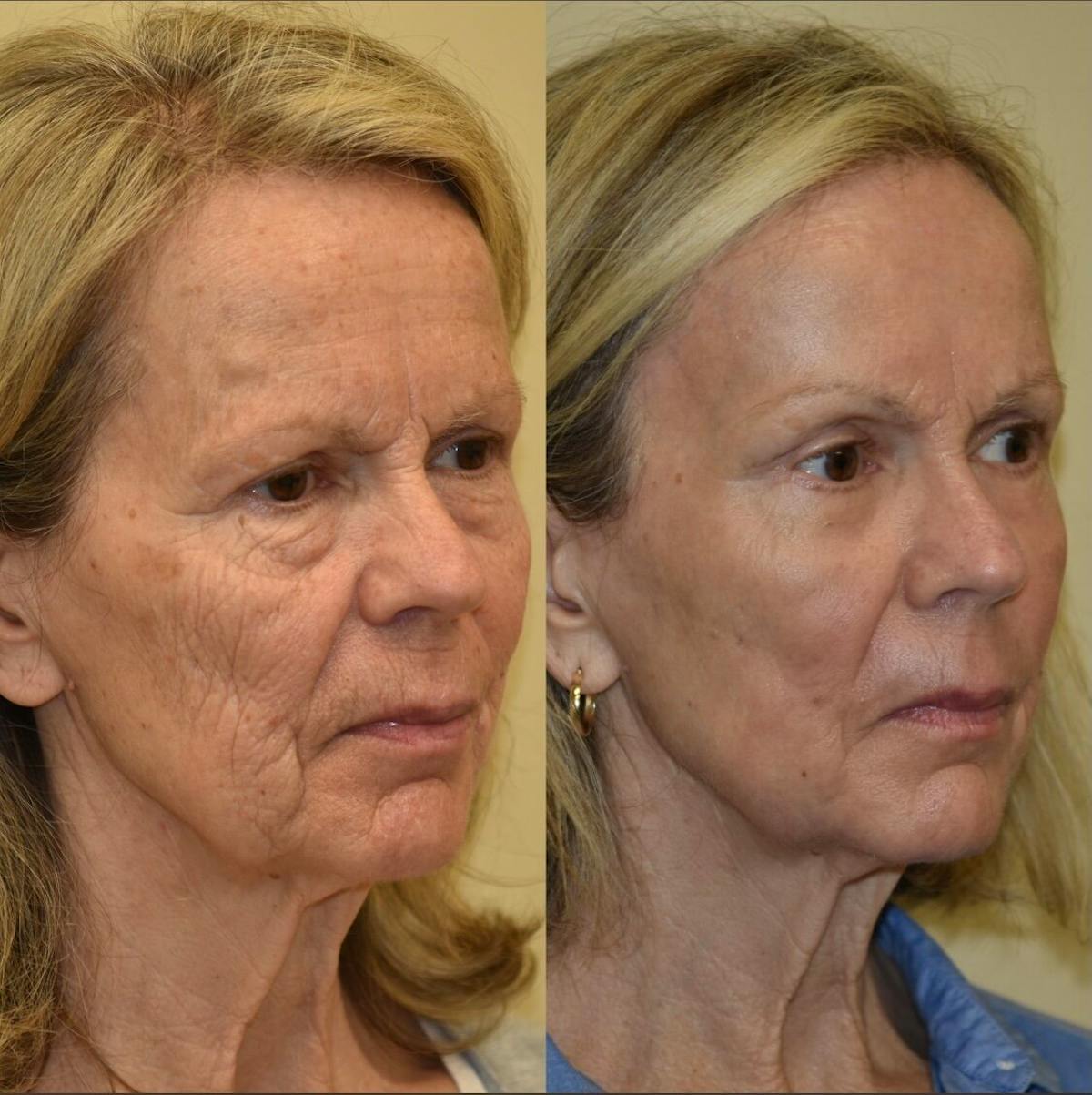 Laser Resurfacing Before & After Gallery - Patient 198138 - Image 1