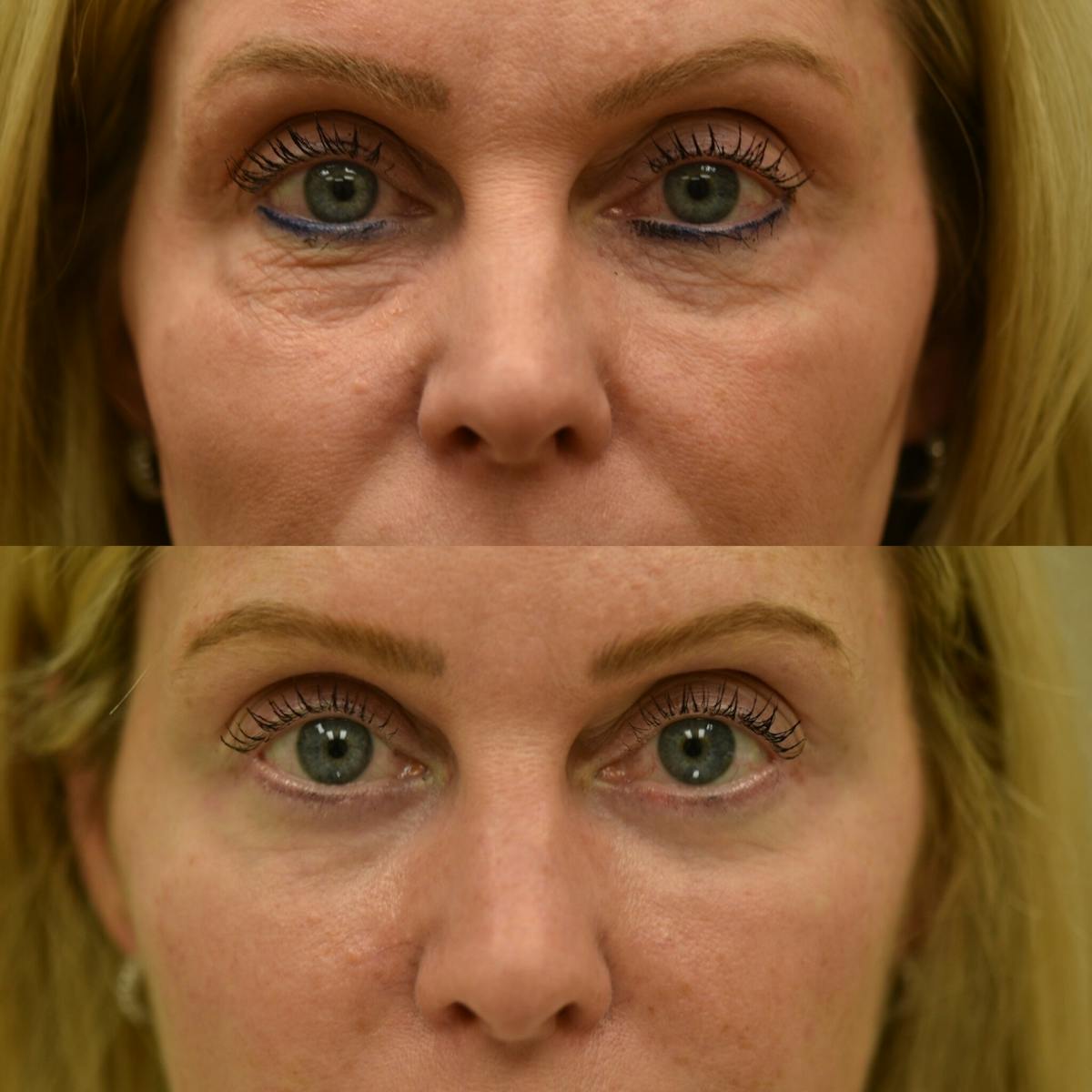 Eyelid Surgery Before & After Gallery - Patient 123927 - Image 1