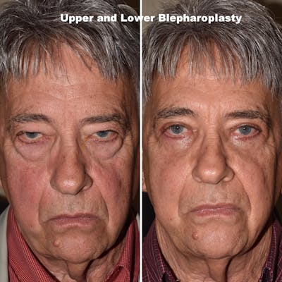 Eyelid Surgery Before & After Gallery - Patient 333504 - Image 1