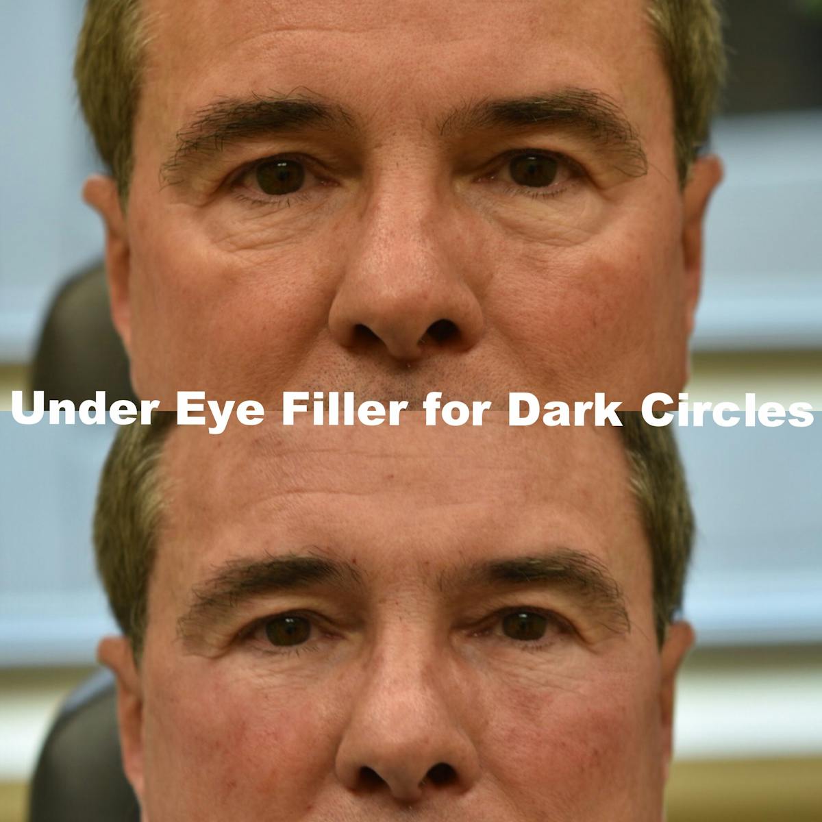 Under Eye Filler Before & After Gallery - Patient 600264 - Image 1
