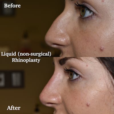 Liquid Rhinoplasty Before & After Gallery - Patient 307243 - Image 1