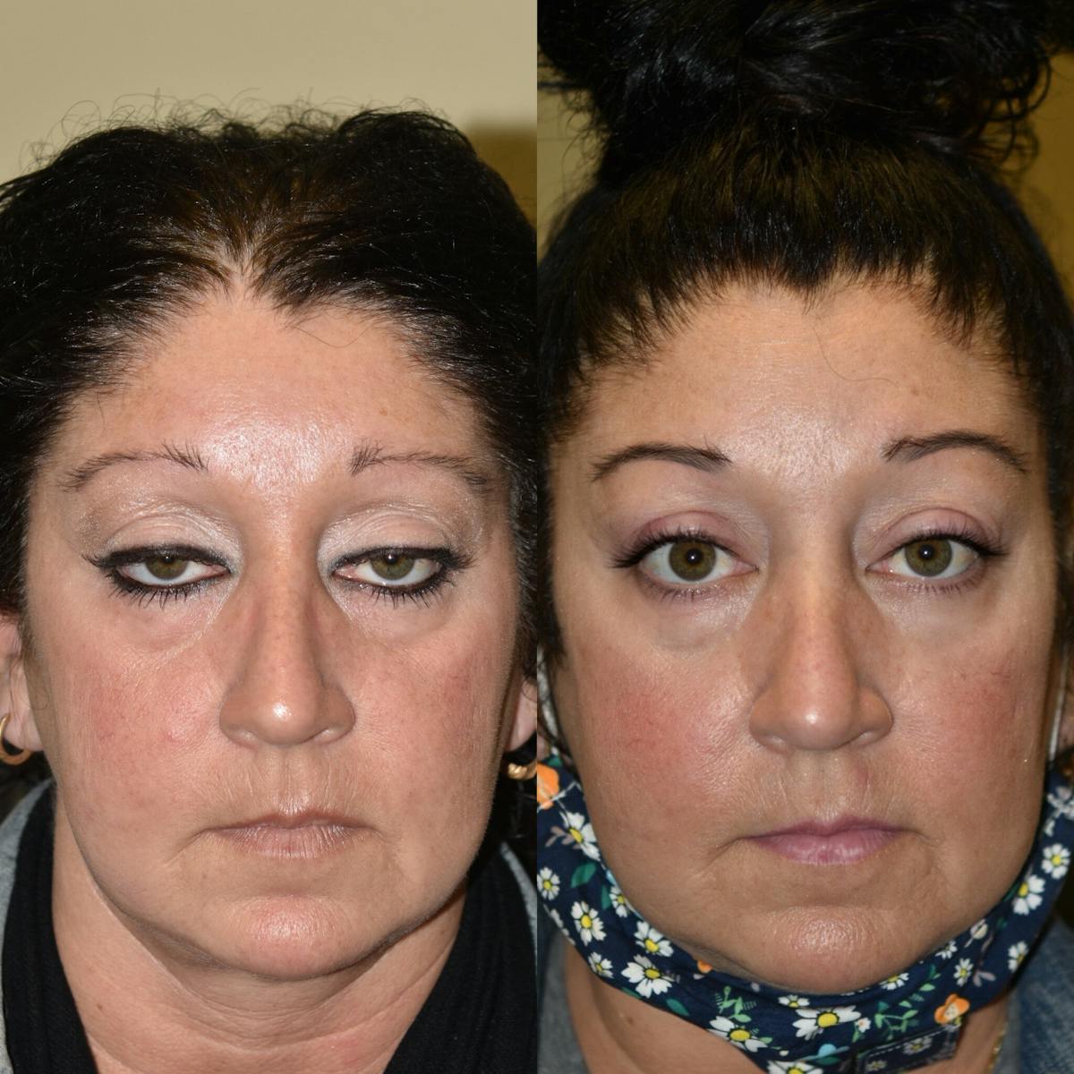 Blepharoplasty (Eyelid Surgery) Before & After Gallery - Patient 287947 - Image 1