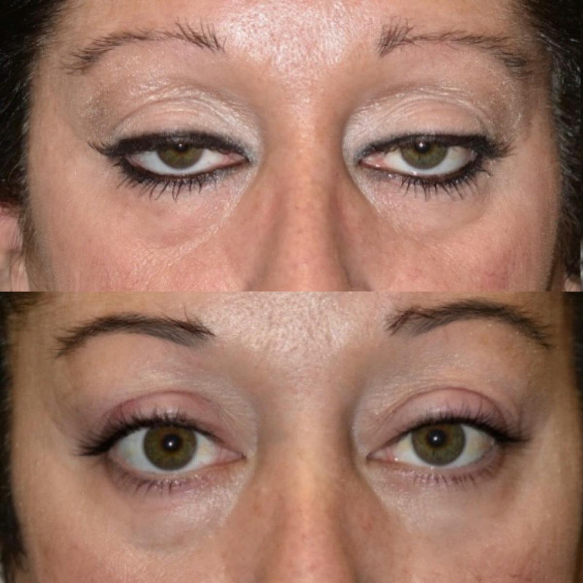 Blepharoplasty (Eyelid Surgery) Before & After Gallery - Patient 287947 - Image 2