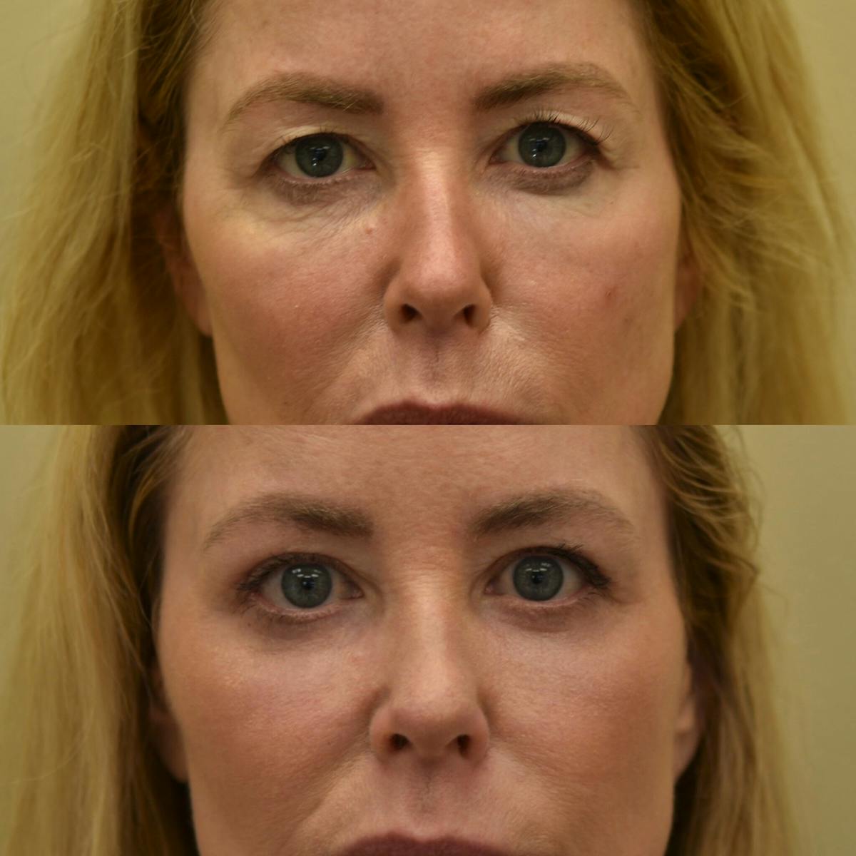 Laser Resurfacing Before & After Gallery - Patient 160648 - Image 2