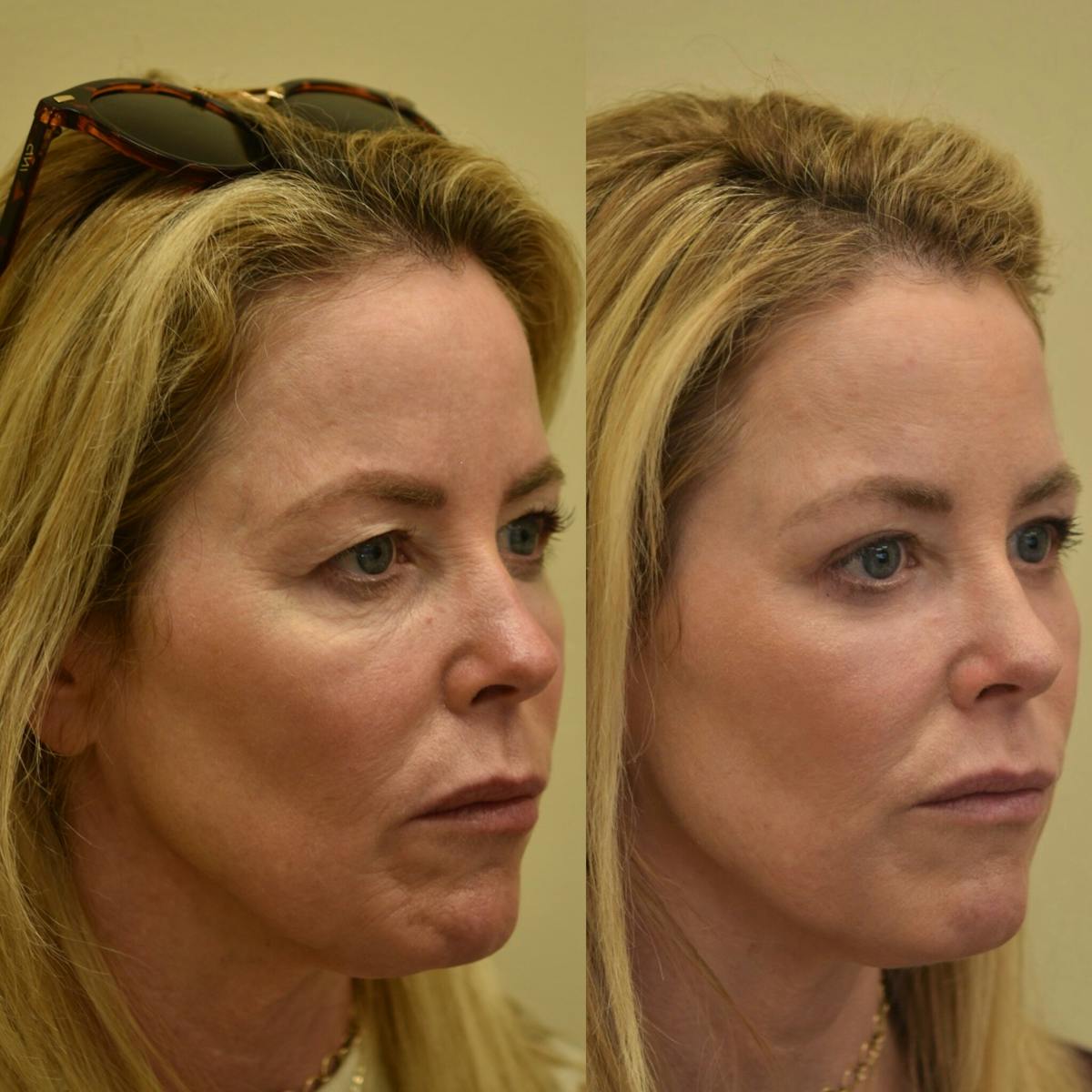 Laser Resurfacing Before & After Gallery - Patient 160648 - Image 1