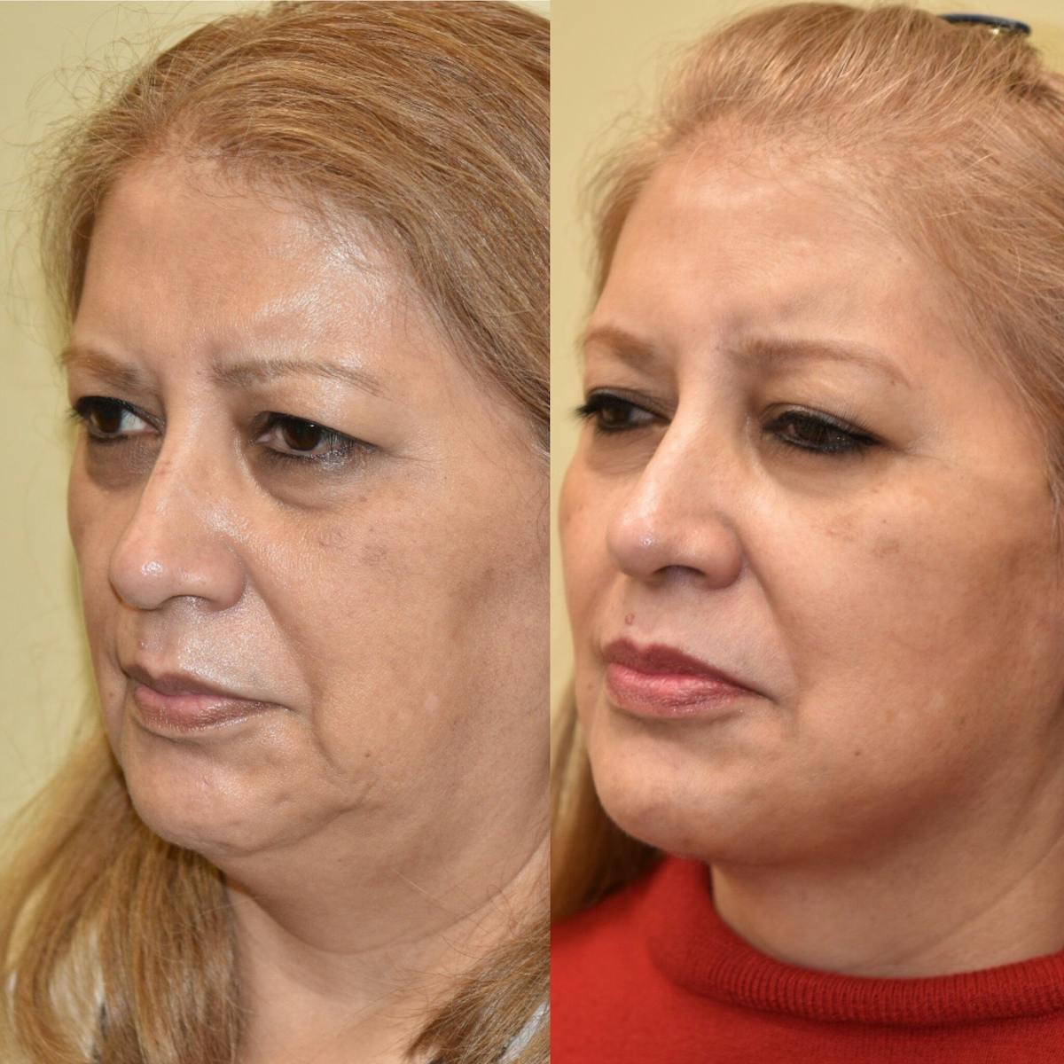 Facelift Before & After Gallery - Patient 248578 - Image 1