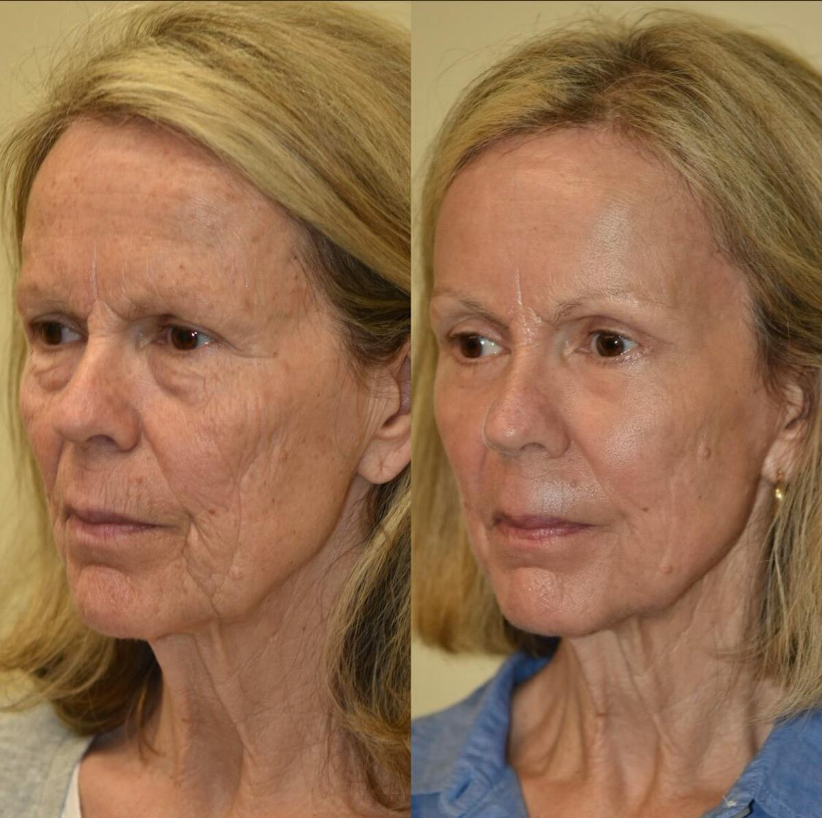 Fat Transfer Before & After Gallery - Patient 151979 - Image 1