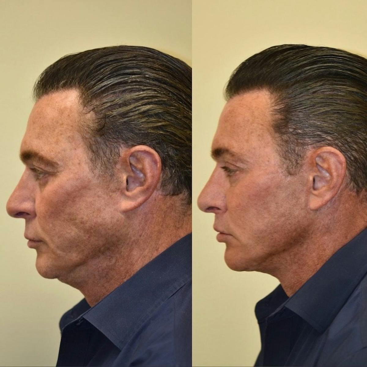 Neck Lift Before & After Gallery - Patient 719508 - Image 3