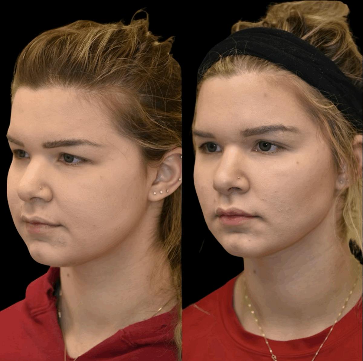 Buccal Fat Reduction Before & After Gallery - Patient 355254 - Image 2