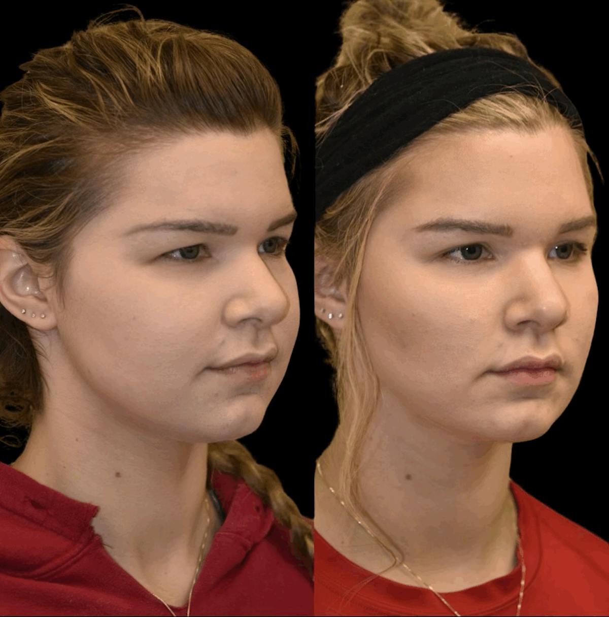 Buccal Fat Reduction Before & After Gallery - Patient 355254 - Image 3