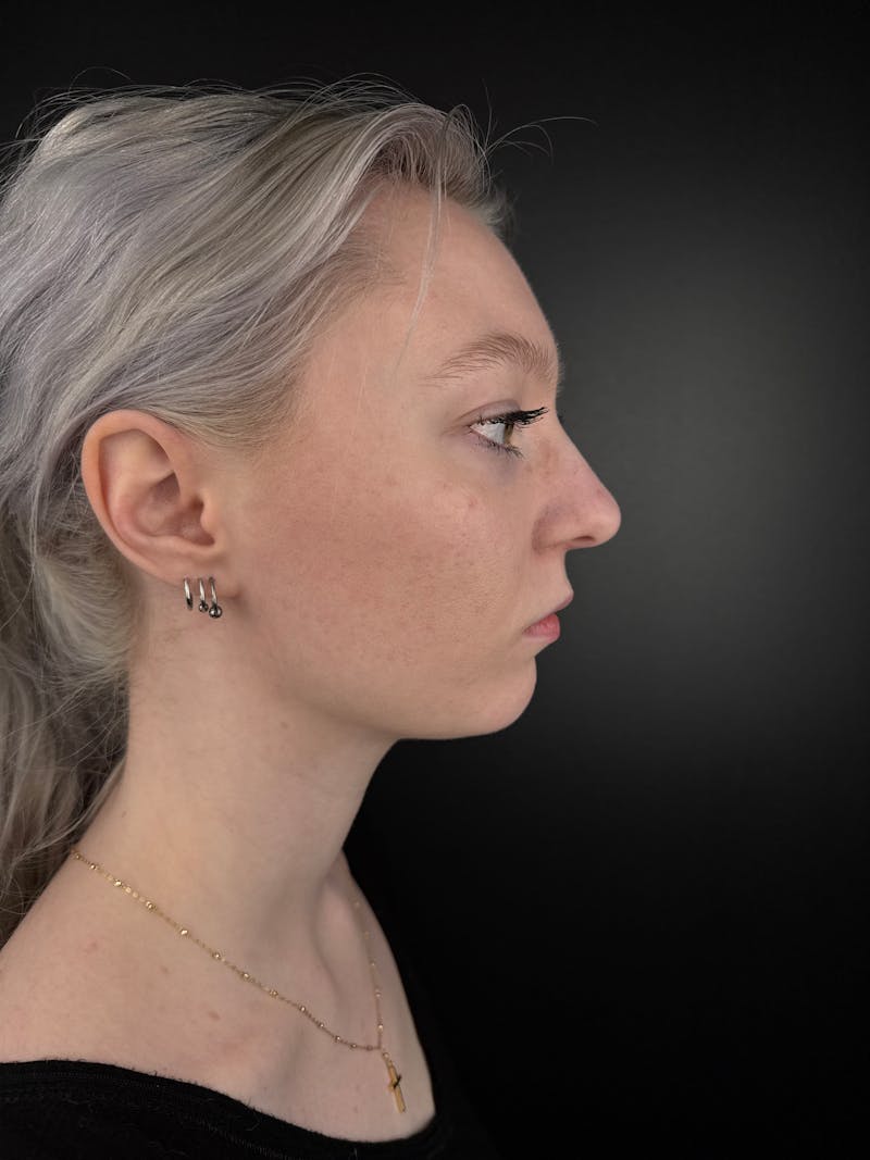 Full Facial Filler Before & After Gallery - Patient 190222 - Image 3