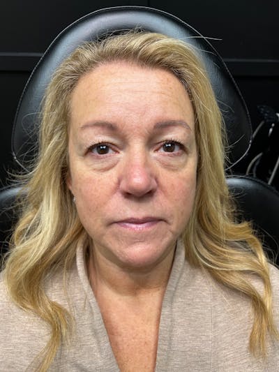 pēko SELF Enhancement (Advanced PRP) Before & After Gallery - Patient 303418 - Image 1