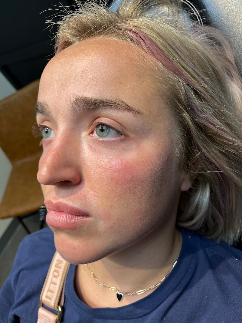 pēko SELF Enhancement (Advanced PRP) Before & After Gallery - Patient 873710 - Image 2