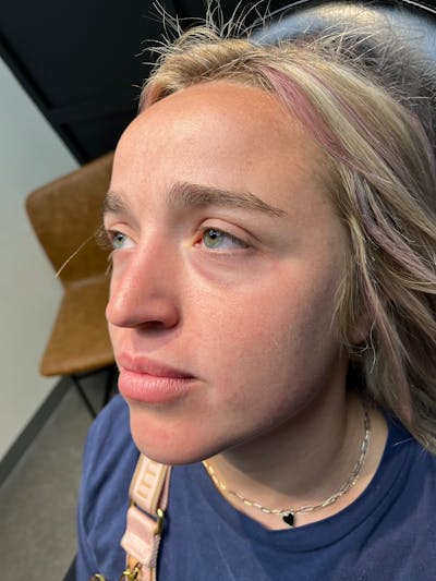 pēko SELF Enhancement (Advanced PRP) Before & After Gallery - Patient 873710 - Image 1