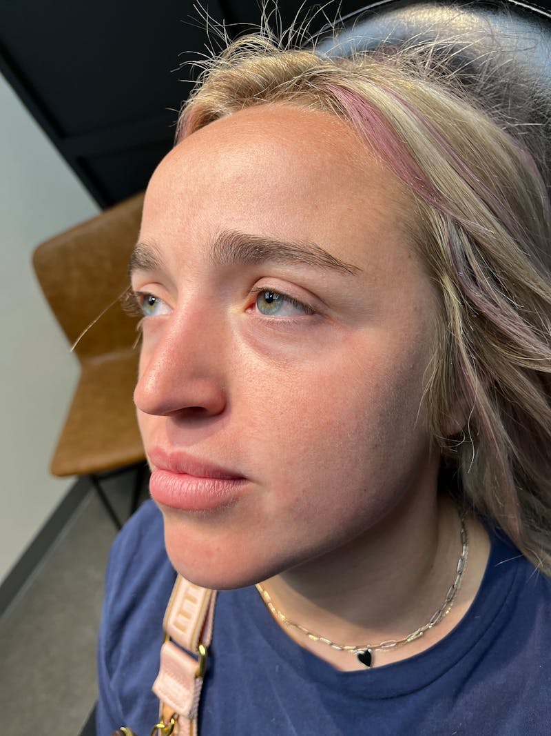 pēko SELF Enhancement (Advanced PRP) Before & After Gallery - Patient 873710 - Image 1