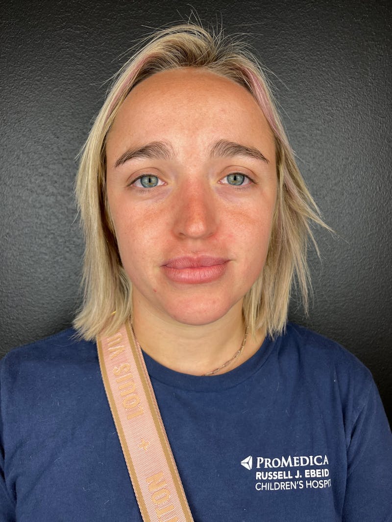 pēko SELF Enhancement (Advanced PRP) Before & After Gallery - Patient 873710 - Image 3