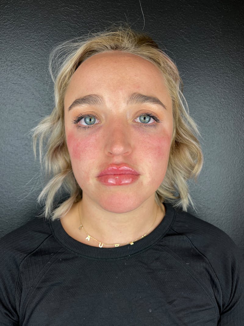 pēko SELF Enhancement (Advanced PRP) Before & After Gallery - Patient 873710 - Image 4