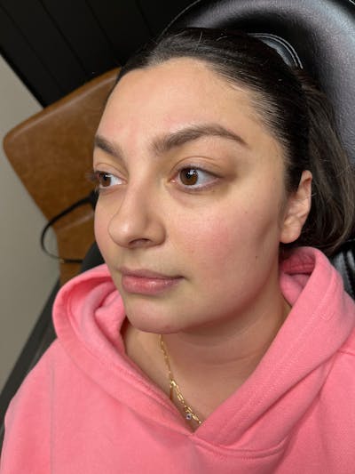 pēko SELF Enhancement (Advanced PRP) Before & After Gallery - Patient 299198 - Image 1