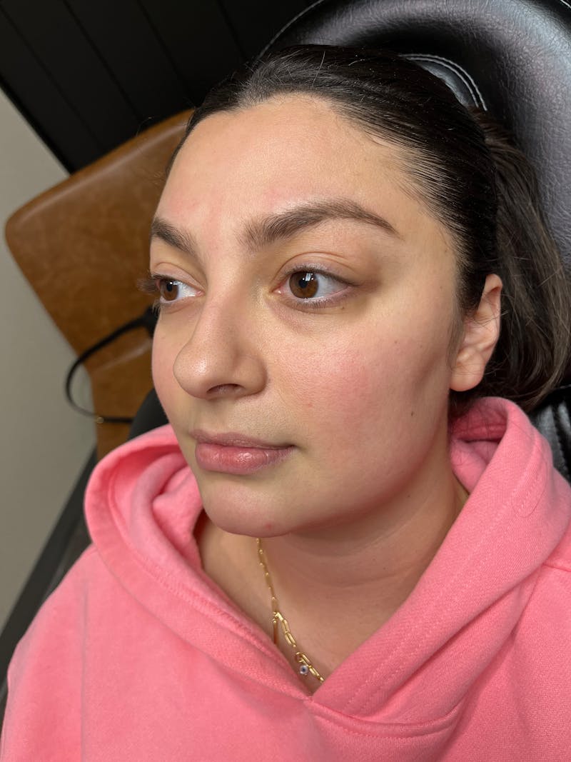 pēko SELF Enhancement (Advanced PRP) Before & After Gallery - Patient 299198 - Image 1