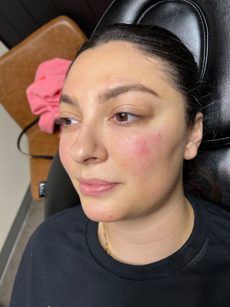pēko SELF Enhancement (Advanced PRP) Before & After Gallery - Patient 299198 - Image 2