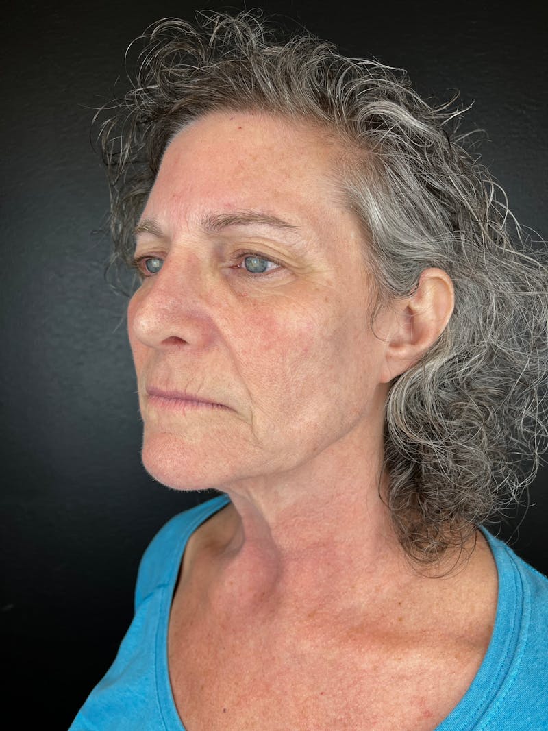 Comprehensive Treatment Plans Before & After Gallery - Patient 343538 - Image 4