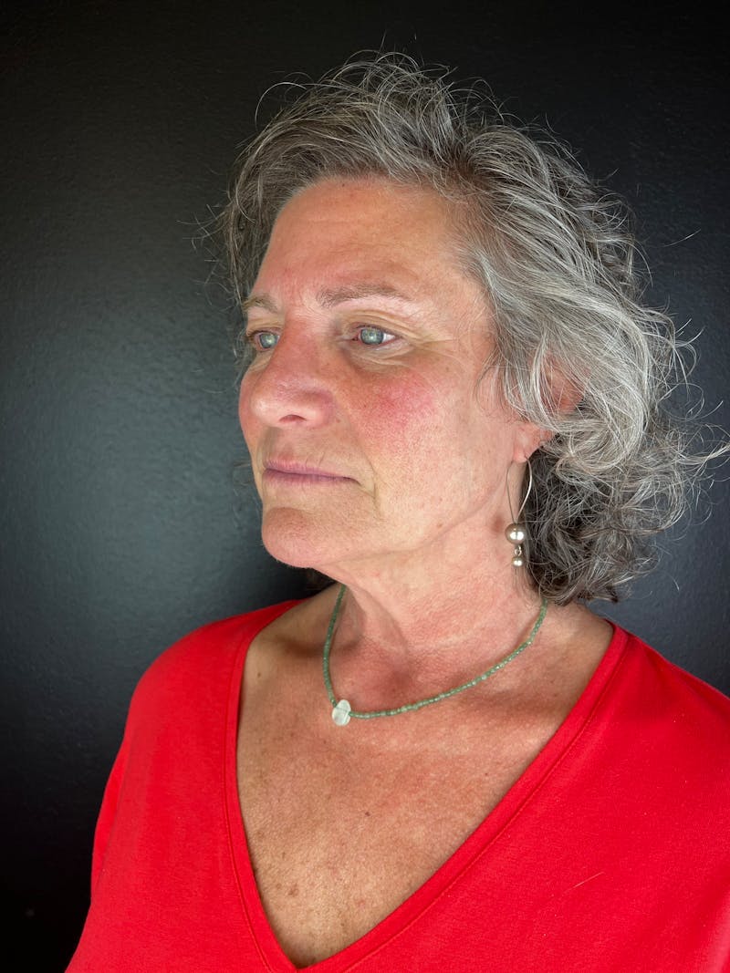 Comprehensive Treatment Plans Before & After Gallery - Patient 343538 - Image 3