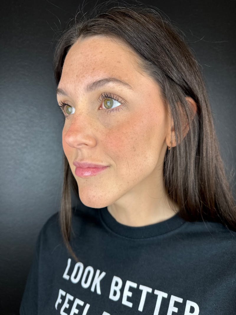 Full Facial Filler Before & After Gallery - Patient 353003 - Image 2