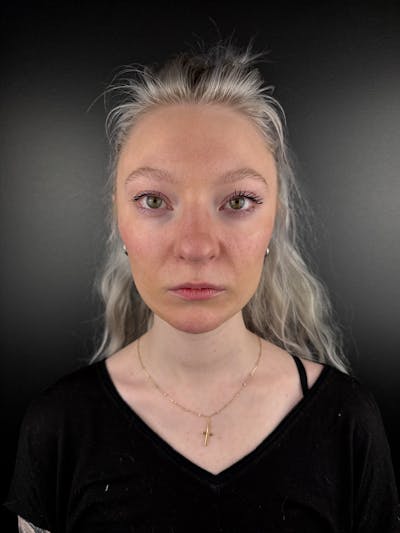 Full Facial Filler Before & After Gallery - Patient 190222 - Image 2