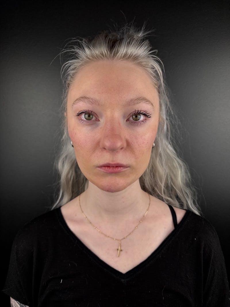 Full Facial Filler Before & After Gallery - Patient 190222 - Image 2