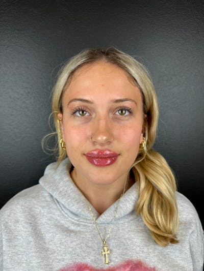 Lip Filler Before & After Gallery - Patient 181441 - Image 2
