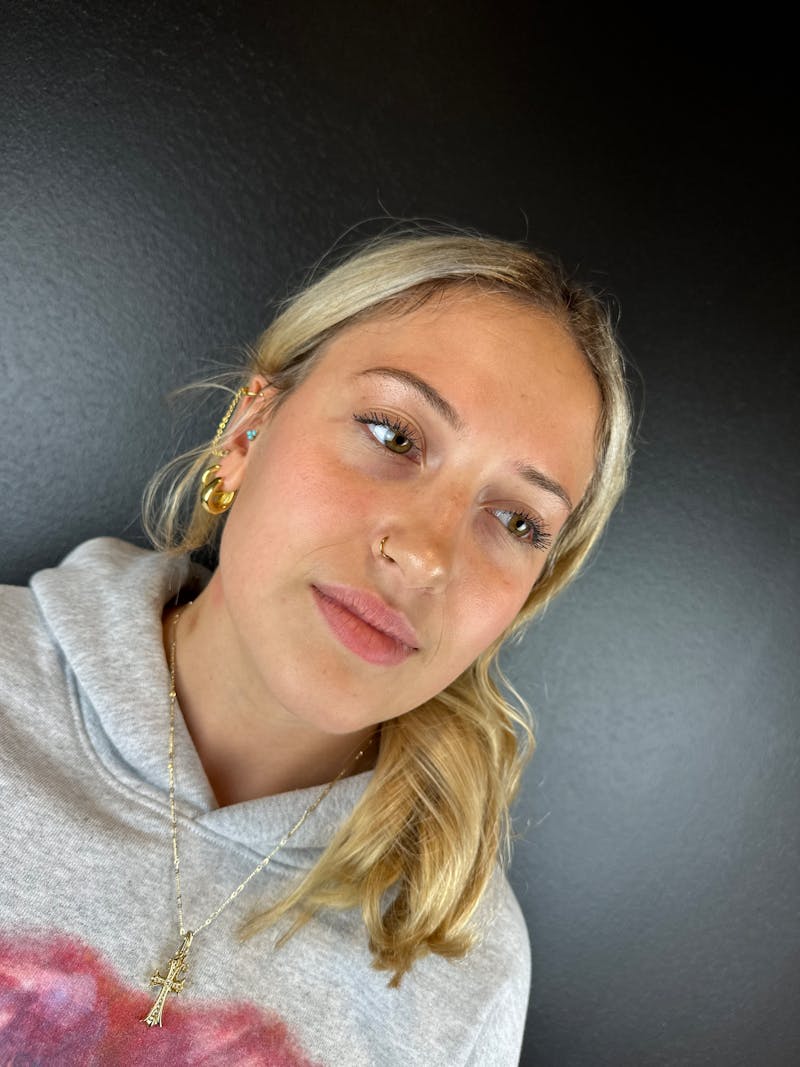 Lip Filler Before & After Gallery - Patient 181441 - Image 3