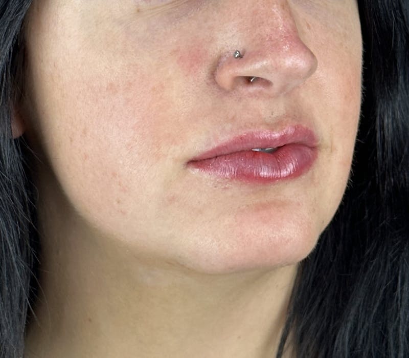 Lip Filler Before & After Gallery - Patient 134104 - Image 6