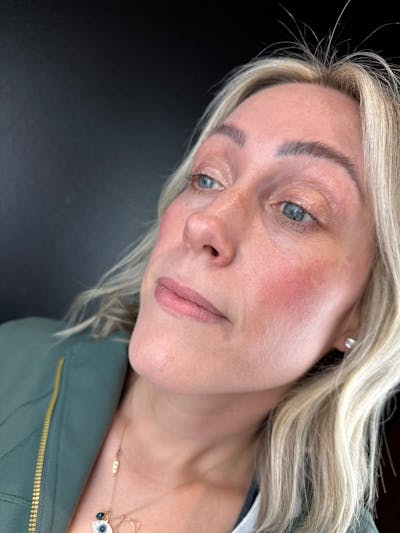 Lip Filler Before & After Gallery - Patient 214210 - Image 1