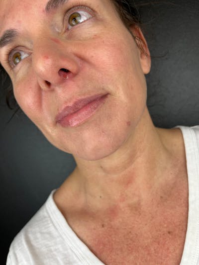 Lip Filler Before & After Gallery - Patient 862820 - Image 1