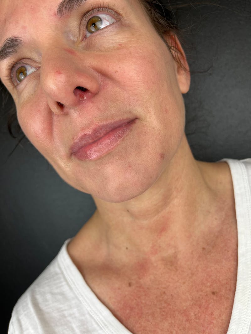 Lip Filler Before & After Gallery - Patient 862820 - Image 1