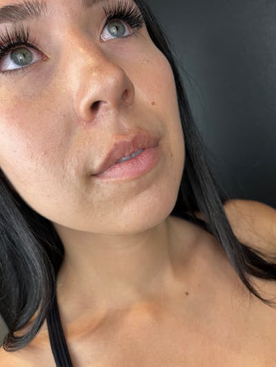 Lip Filler Before & After Gallery - Patient 333938 - Image 1