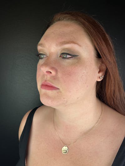 Lip Filler Before & After Gallery - Patient 106032 - Image 1