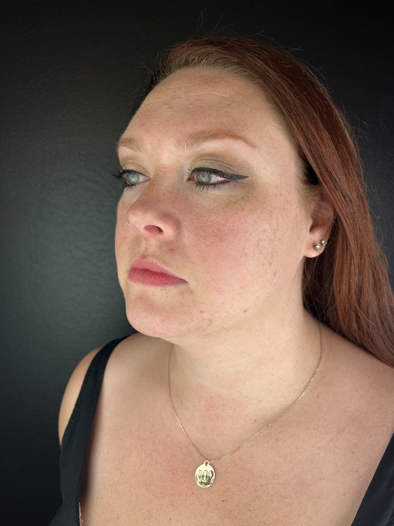 Lip Filler Before & After Gallery - Patient 106032 - Image 1