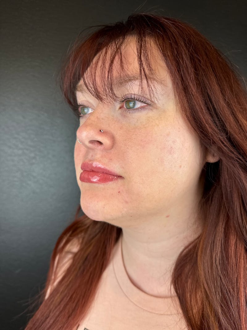 Lip Filler Before & After Gallery - Patient 106032 - Image 2