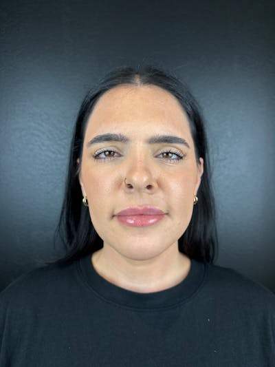Lip Filler Before & After Gallery - Patient 379289 - Image 2