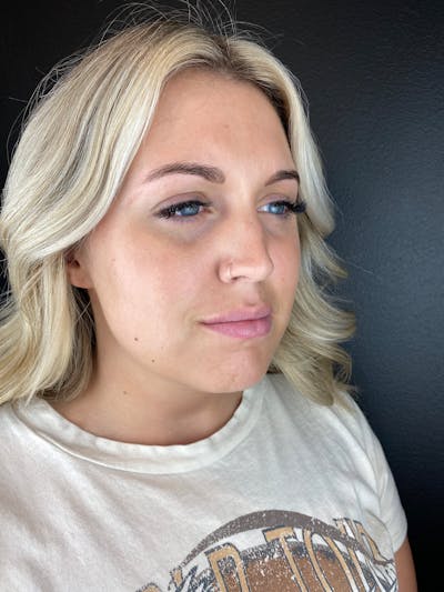 Lip Filler Before & After Gallery - Patient 260029 - Image 1