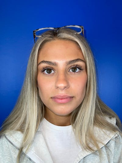 Lip Filler Before & After Gallery - Patient 250599 - Image 1