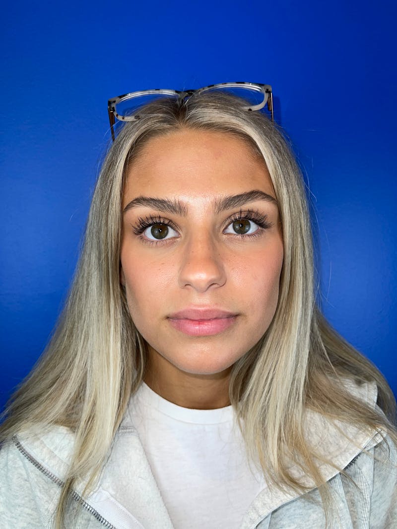 Lip Filler Before & After Gallery - Patient 250599 - Image 1