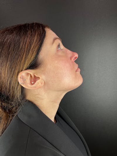 Liquid Rhinoplasty Before & After Gallery - Patient 552824 - Image 2