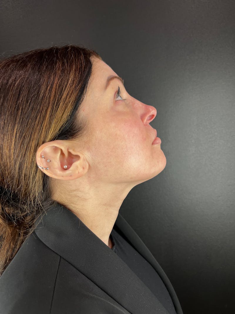 Liquid Rhinoplasty Before & After Gallery - Patient 552824 - Image 2