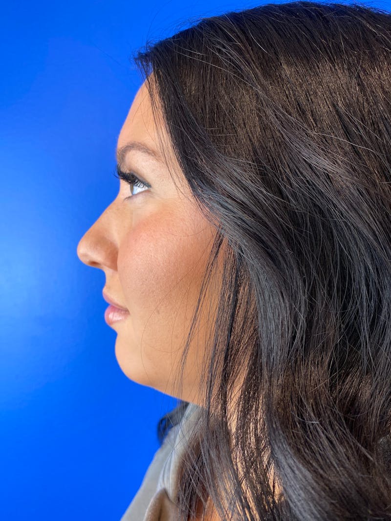 Liquid Rhinoplasty Before & After Gallery - Patient 288829 - Image 1
